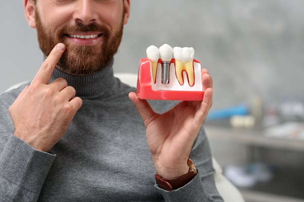 What To Ask Your Dentist About Dental Implants